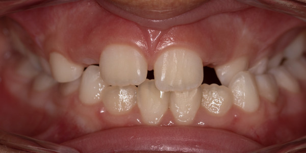 Лечение на кръстосана захапка в страничен участък при дете на 7 години