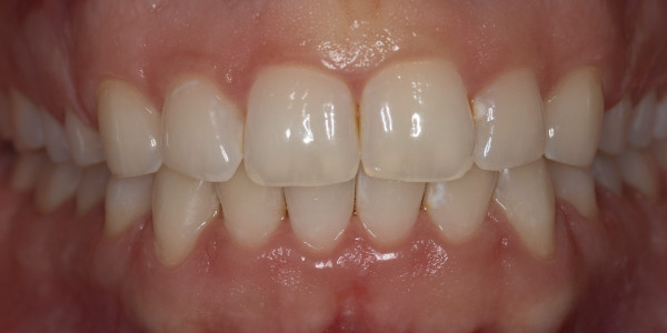 Orthodontic treatment of upper and lower jaw crowding