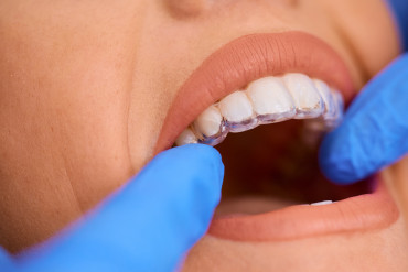 Избелване на зъби